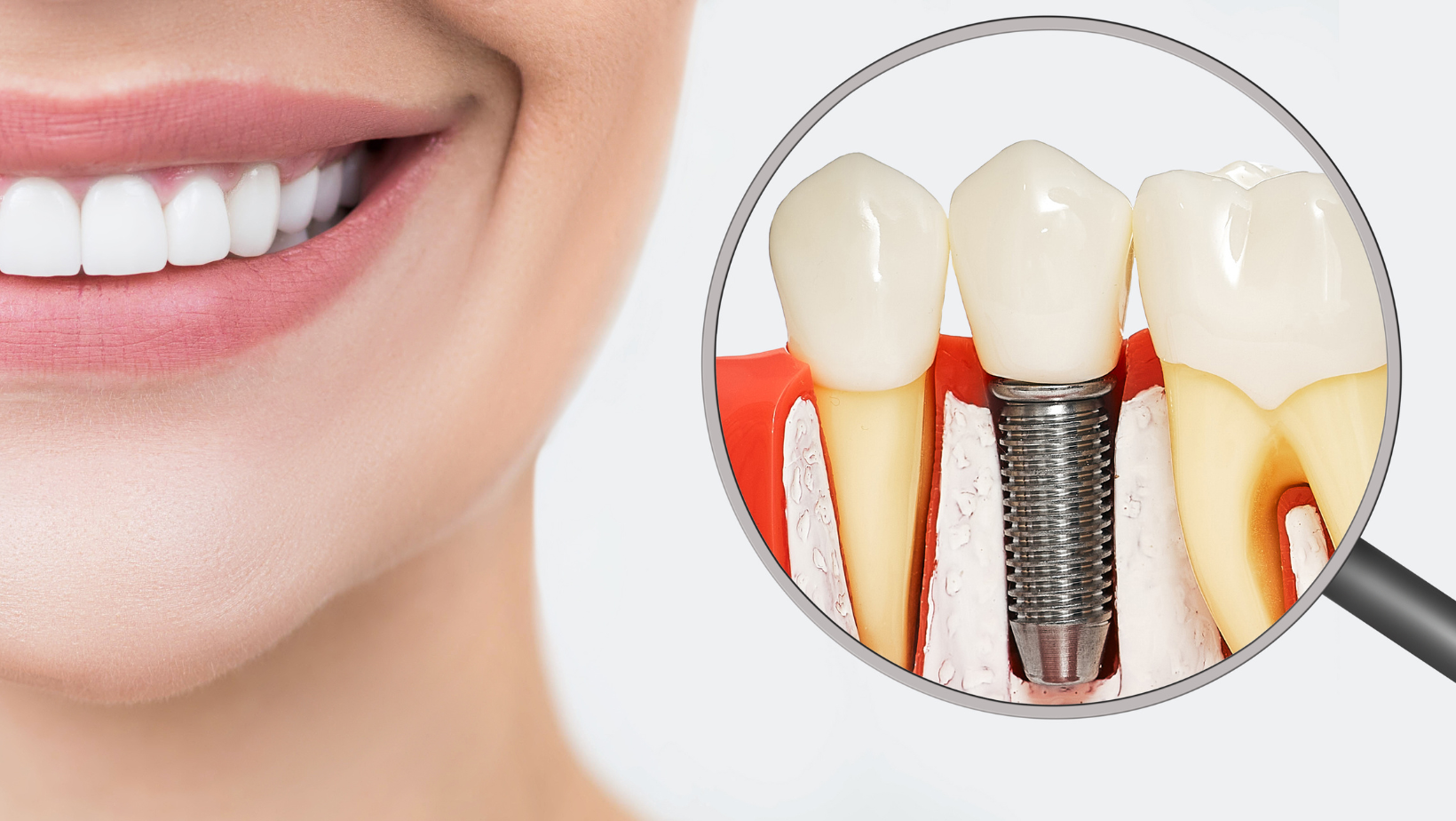 danties implantavimas